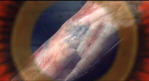 Dr. Xavier (Ray Milland) can see an accident victim's broken bone in Roger Corman’s X: The Man with the X-Ray Eyes (1963)